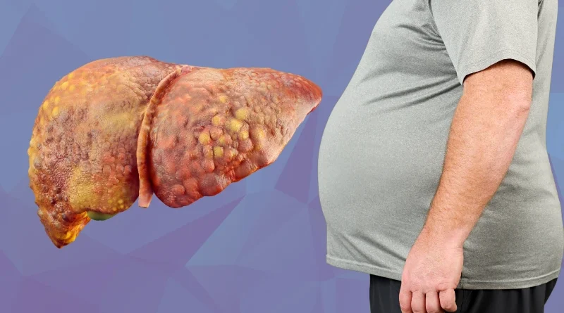 Fatty Liver Symptoms